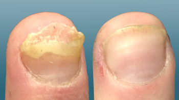 Лечение грибка ногтей лазером NeoNail, Украина