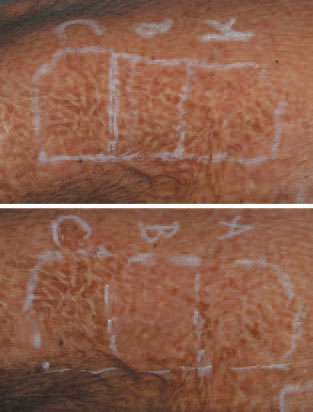 Шрам после ожога до и после лечения фракционным лазером MedArt FRx
