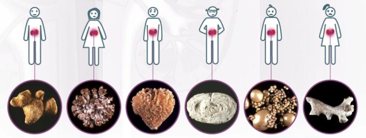 Оксалатні камені в нирках: що варто знати та як зменшити ризики